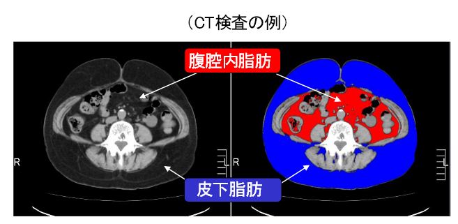 CT脂肪画像