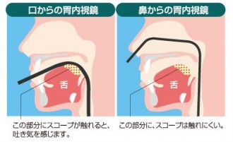 stomachendoscopy